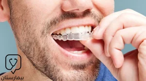 Ortodontik atel şeffaf kalıplar şeklinde gelir.