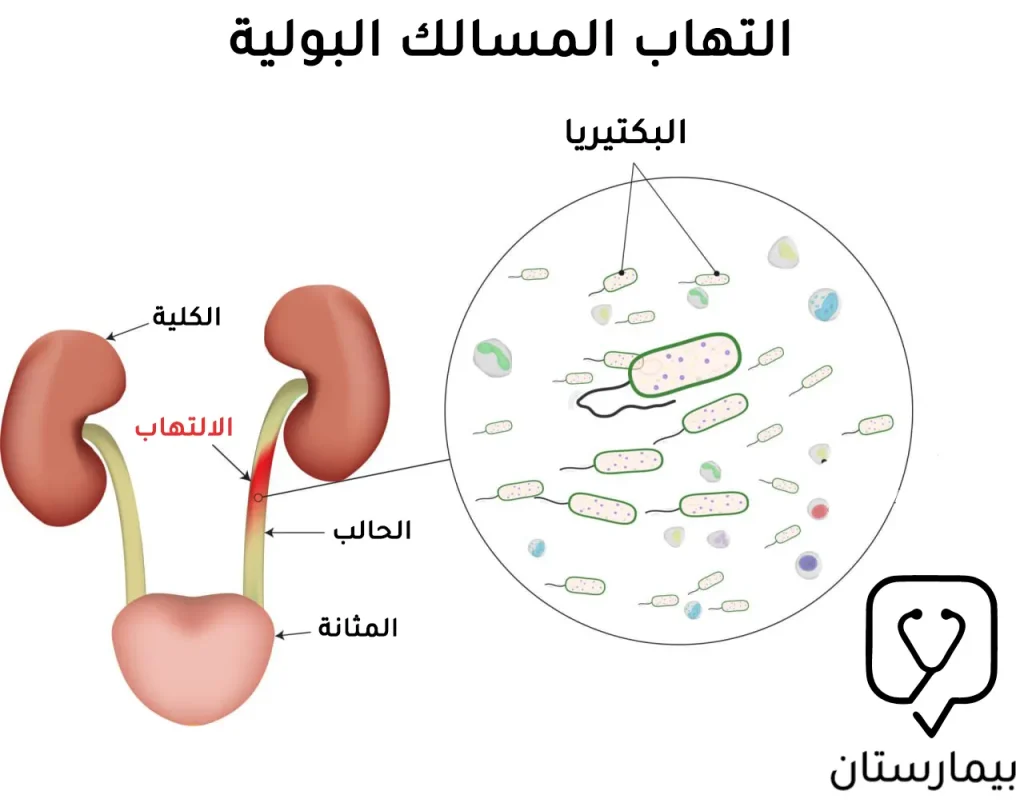 صورة توضح كيفية إحداث البكتيريا لالتهاب المسالك البولية عند النساء