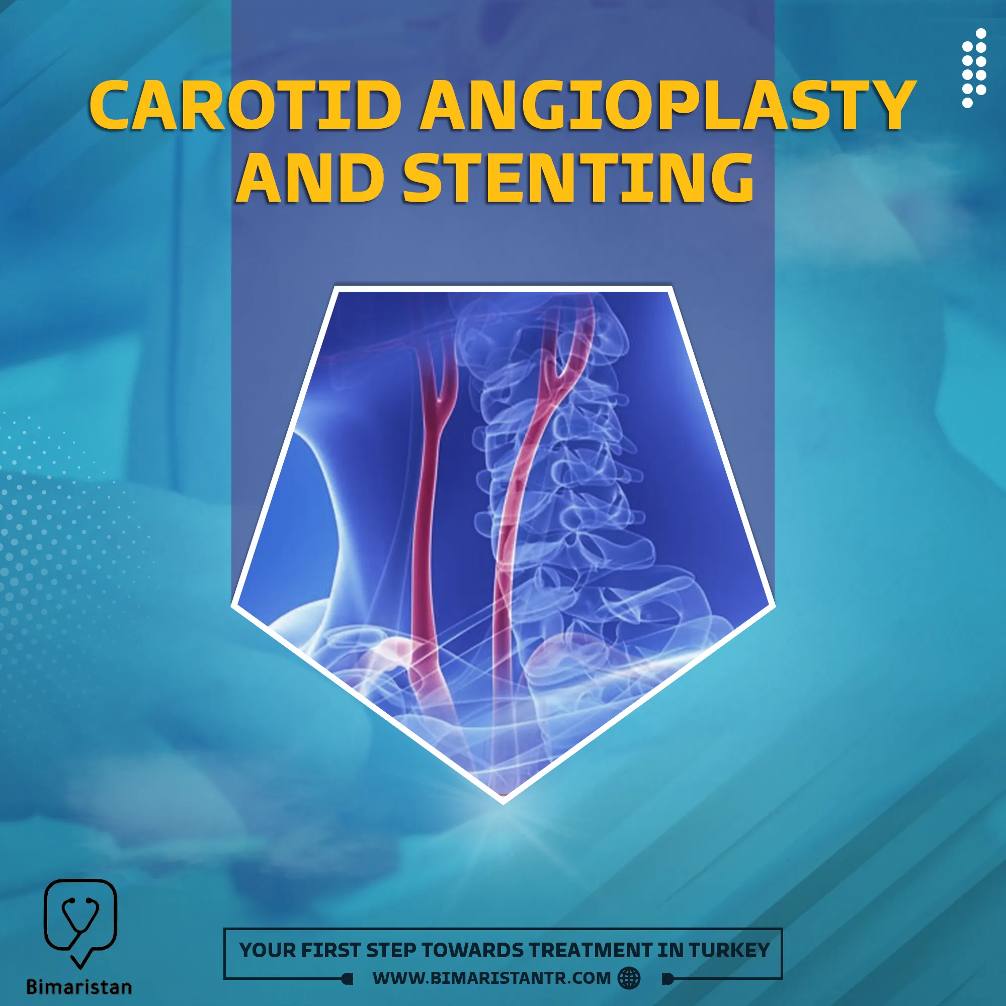 Carotid angioplasty and stenting