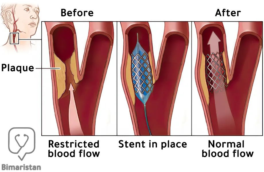 Image showing blood flow through the carotid artery before and after carotid angioplasty and stenting