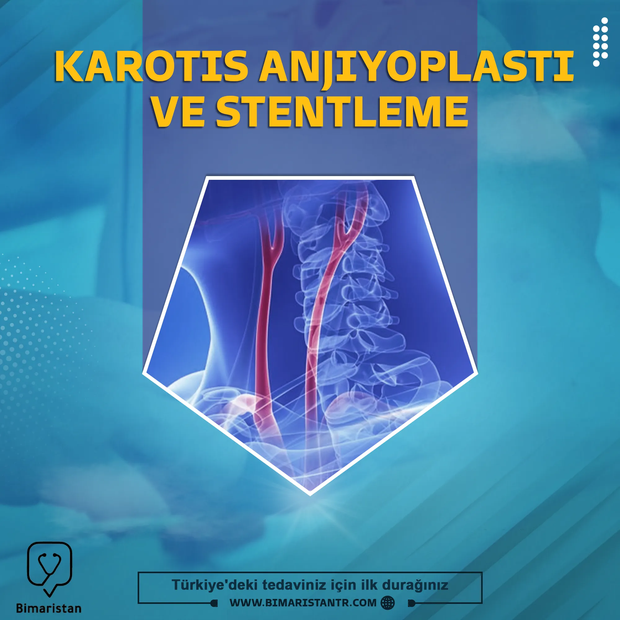 Karotis arter anjiyoplasti ve stent yerleştirme