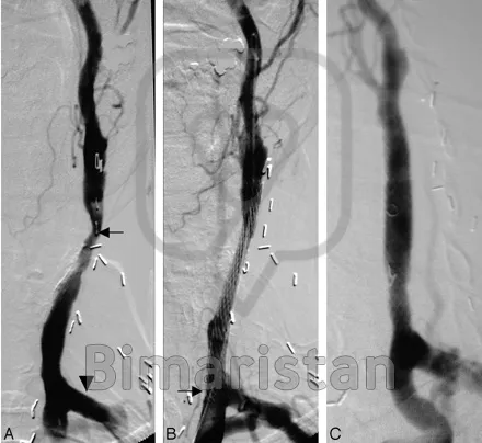 Angiography of the carotid artery before and after carotid angioplasty and stenting