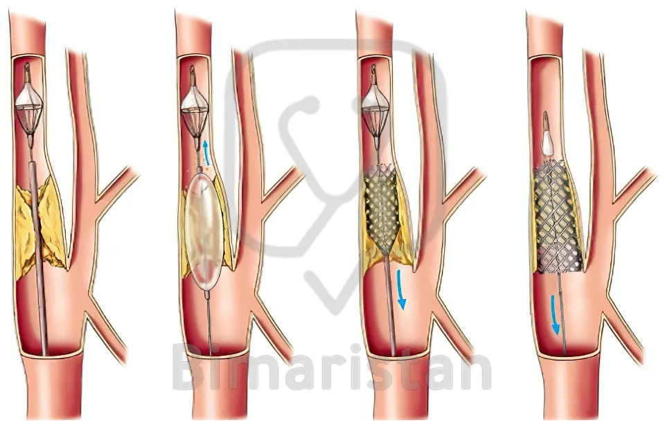 Karotis arter anjiyoplasti ve stent yerleştirme aşamalarını gösteren görüntü