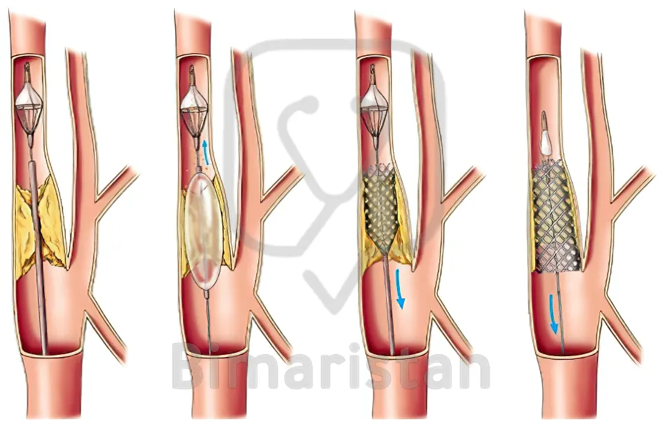 Операция стентирование. Стентирование шейных артерий. Ангиопластика сонной артерии. Стентирование сонойартерии. Стентирование сонной артерии.