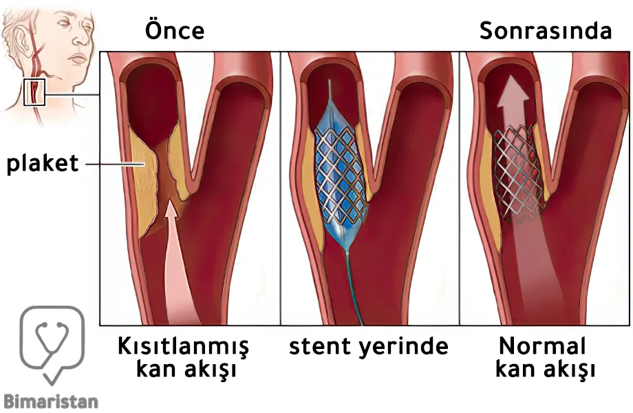 Karotis anjiyoplastisi ve stent yerleştirilmesinden önce ve sonra karotid arterden kan akışını gösteren resim