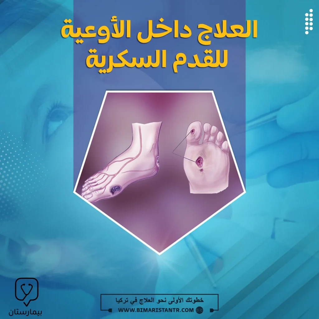 العلاج داخل الأوعية للقدم السكرية