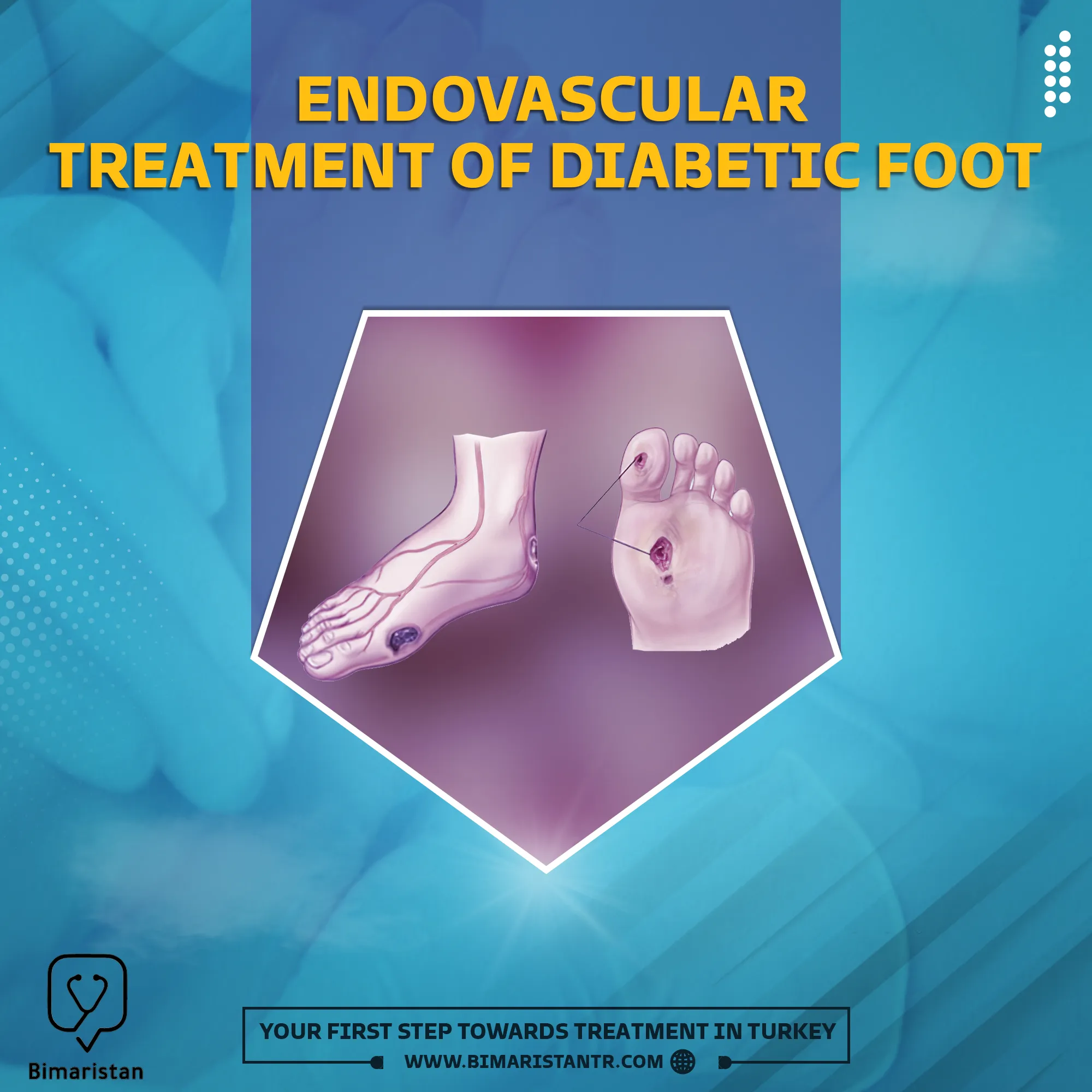Endovascular treatment of the diabetic foot
