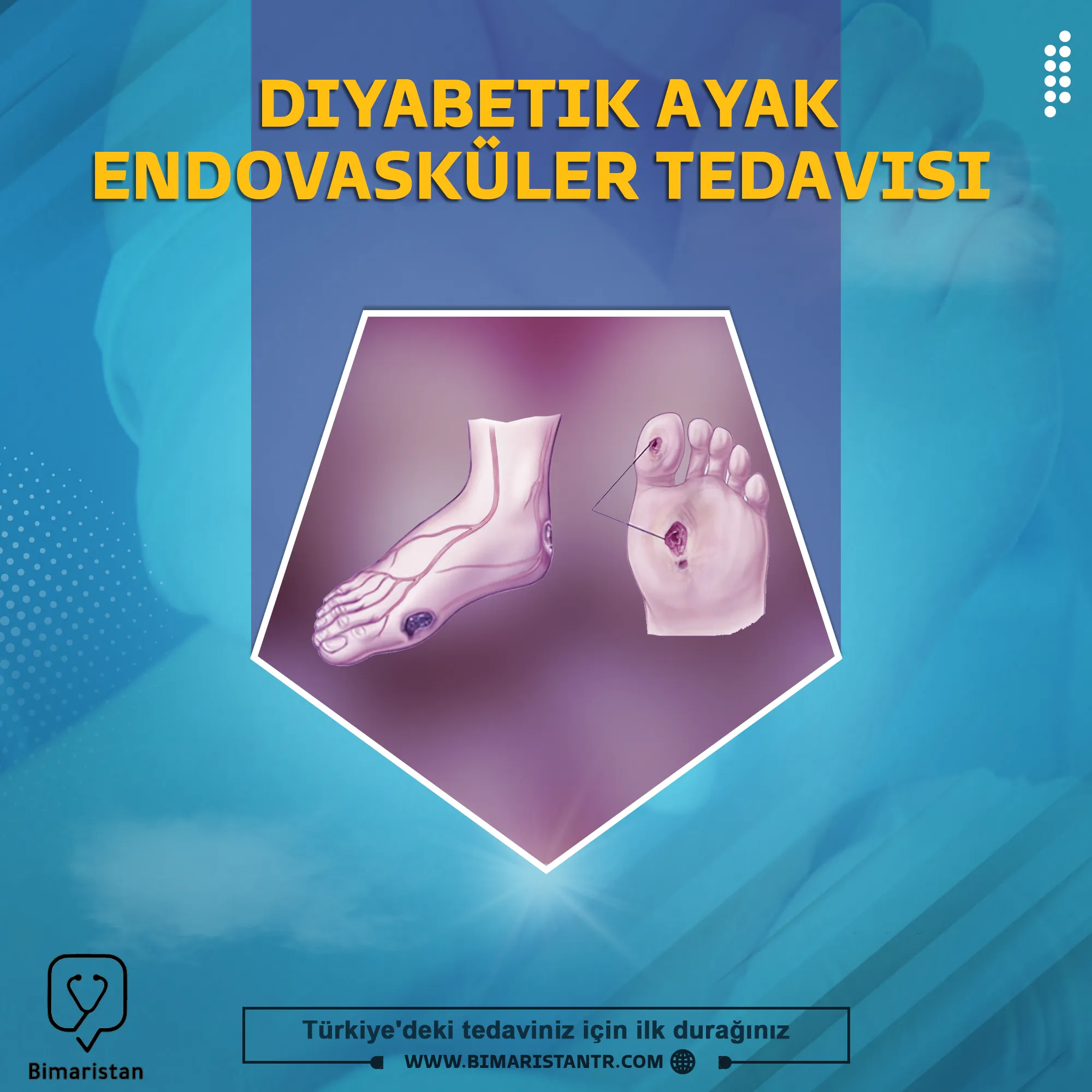 Diyabetik ayağın endovasküler tedavisi