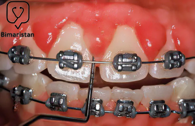 Gum enlargement due to orthodontics