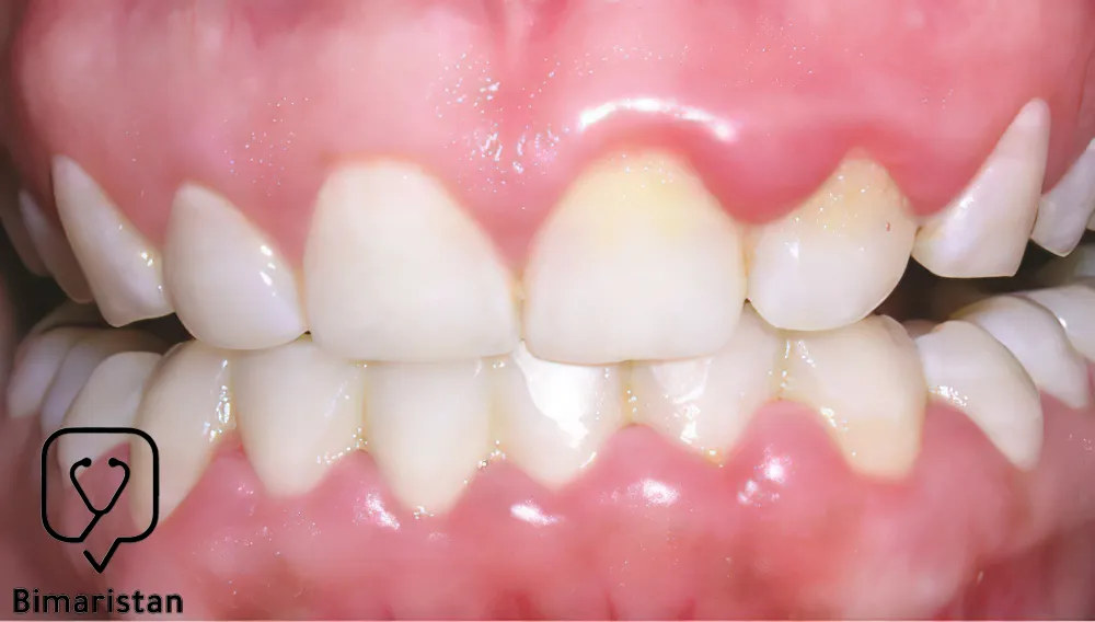 Swelling and enlargement of the edges of the gums