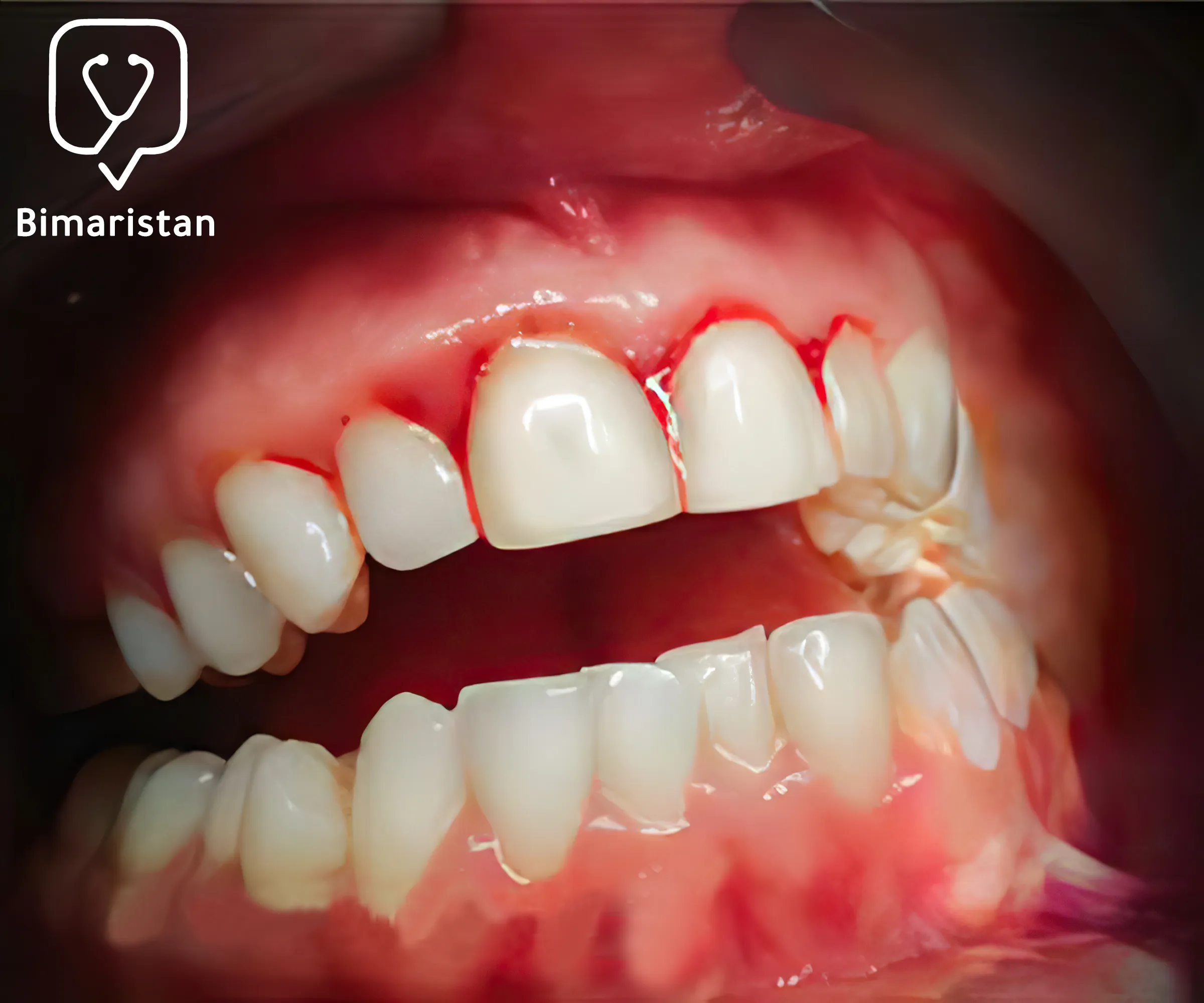 After gingival surgery to treat gingival hyperplasia