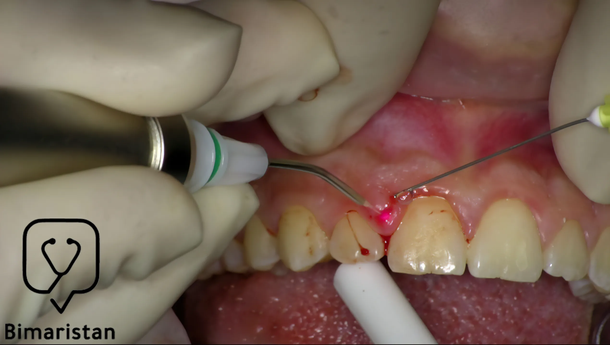 Laser periodontal surgery to treat gingival enlargement in Turkey