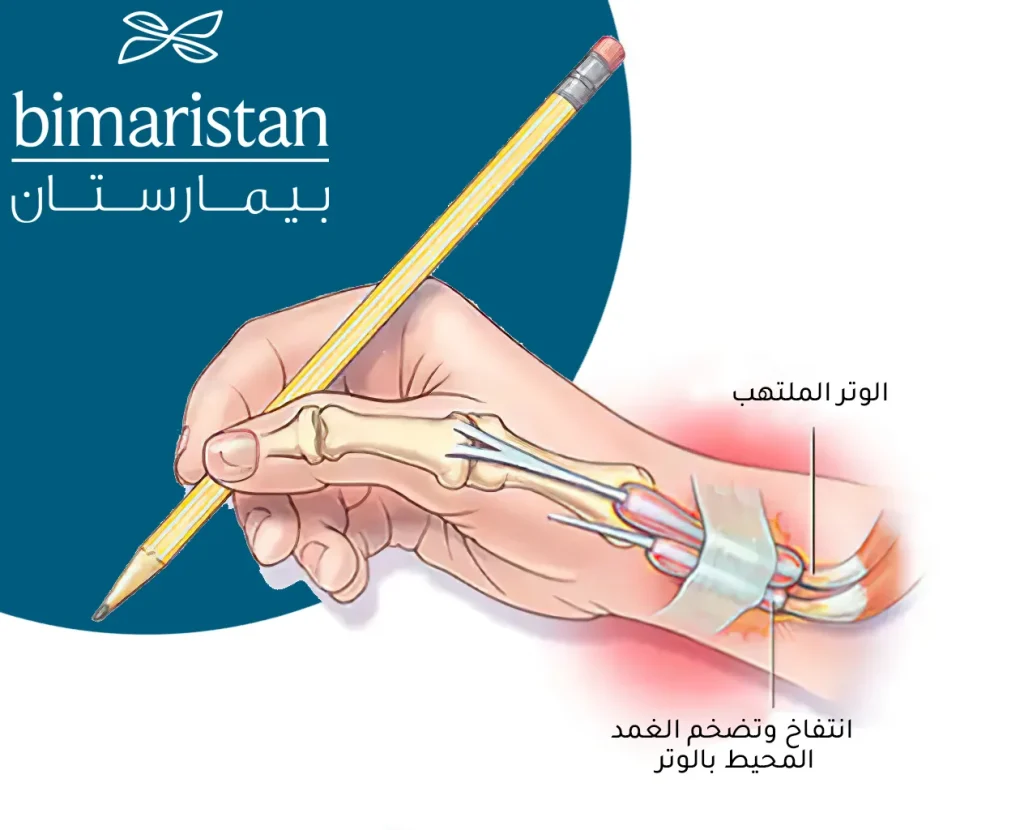صورة توضح حالة التهاب اوتار اليد والتي غالبًا ما تنتج عن فرط استخدام اليدين
