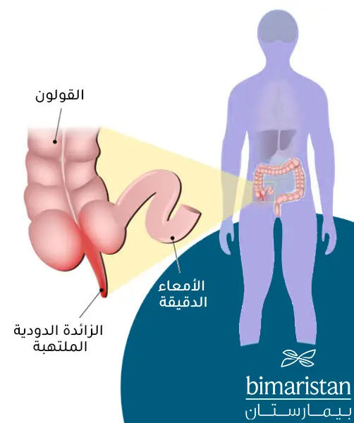 صورة تظهر التهاب الزائدة الدودية البسيط وموقع الزائده التشريحي في الجسم
