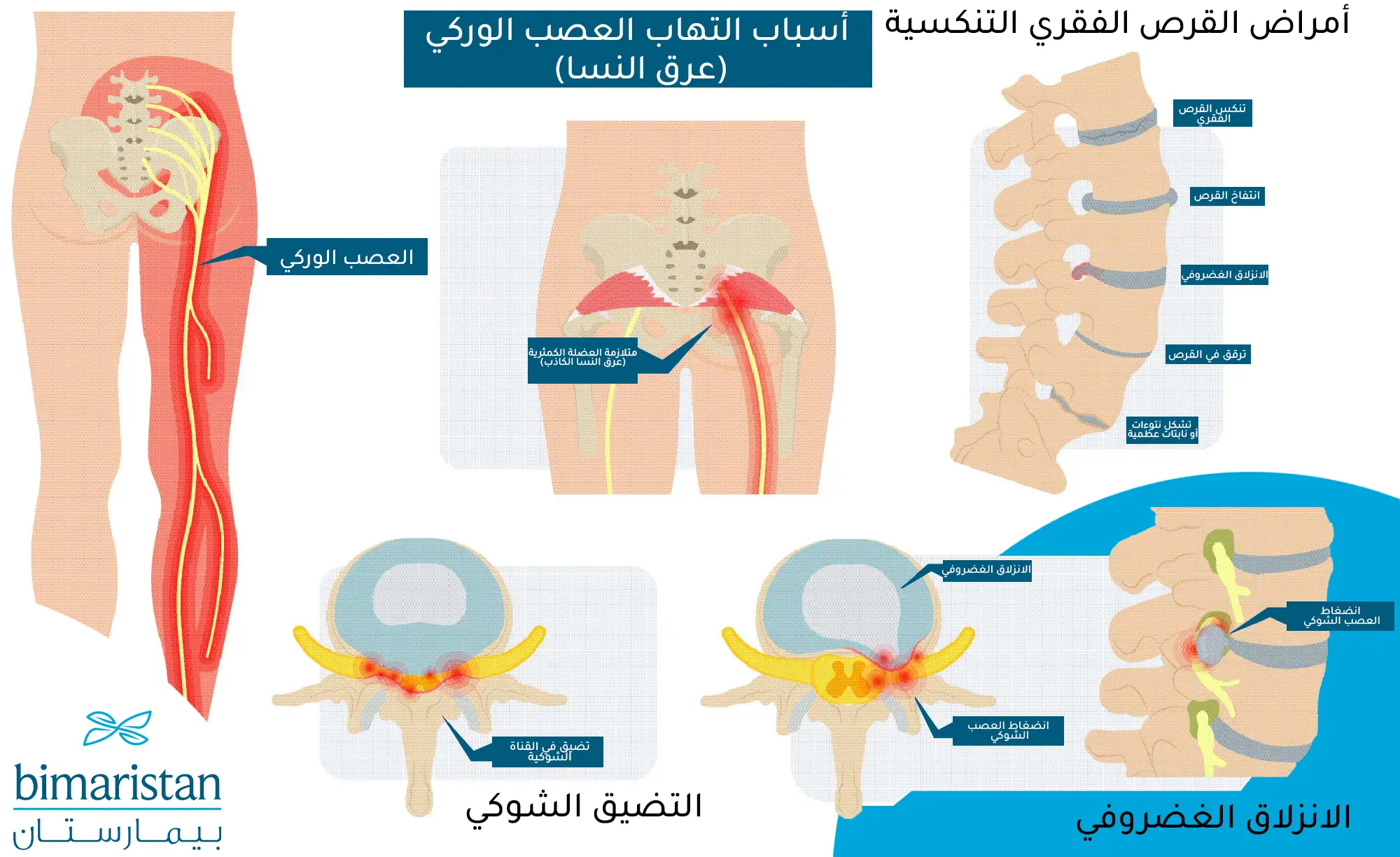 Causes of sciatic nerve inflammation and the neurological and orthopedic conditions causing it
