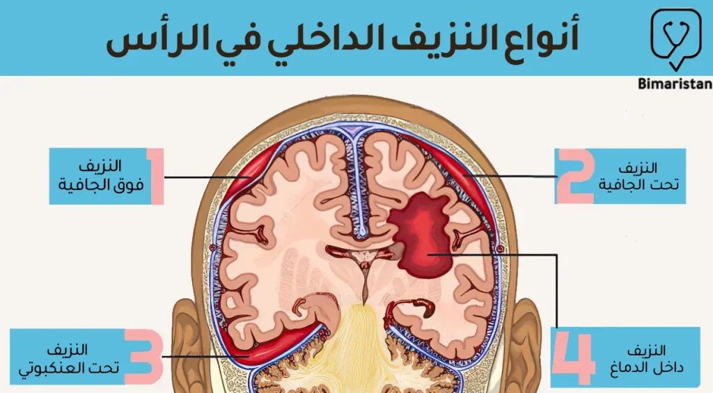 أنواع النزيف الداخلي في الرأس والذي يقسم بشكل رئيسي للنزيف السحائي والنزف داخل الدماغ