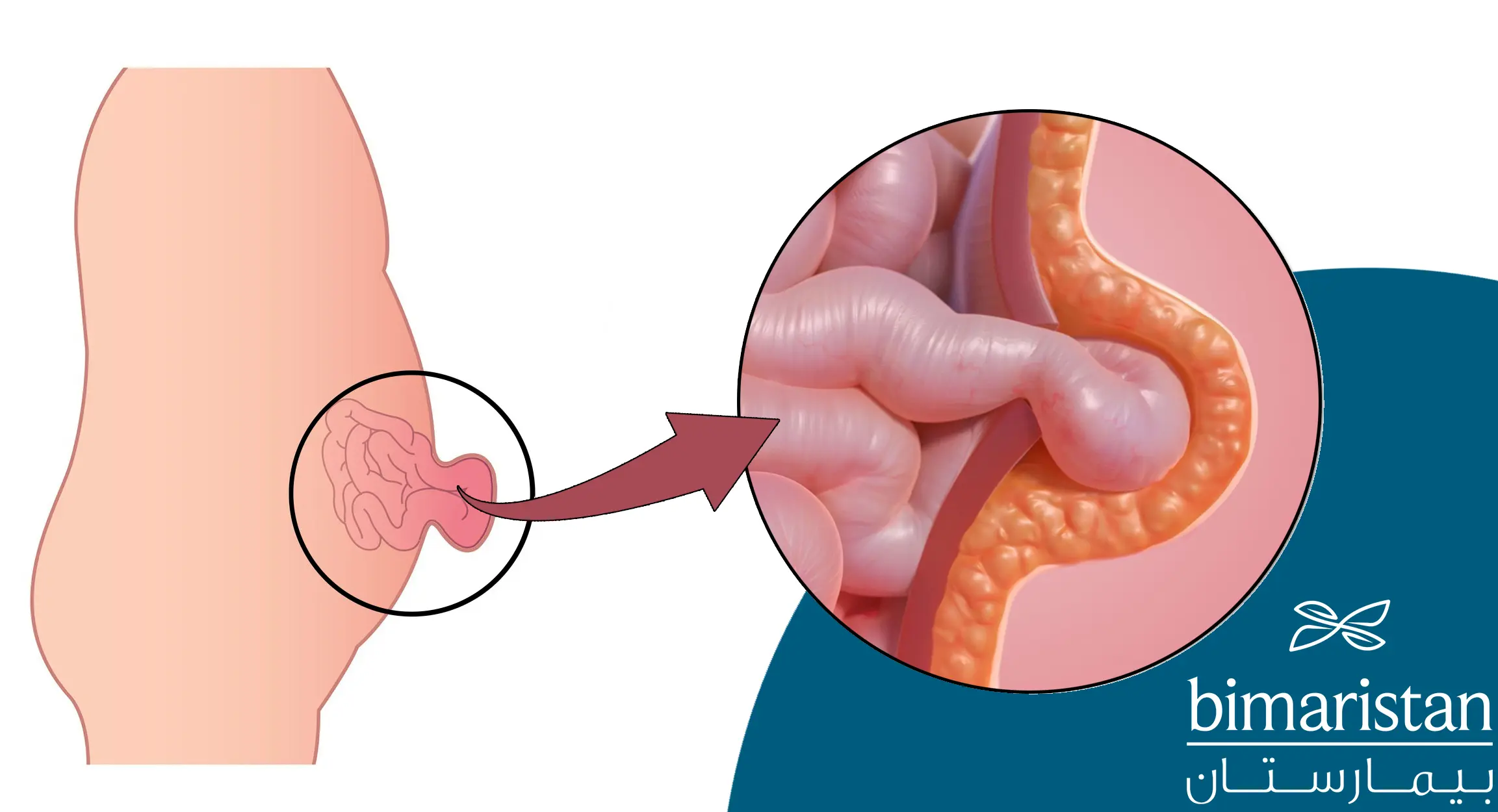 صورة ترسيمية توضح انفتاق الأمعاء عبر السرة
