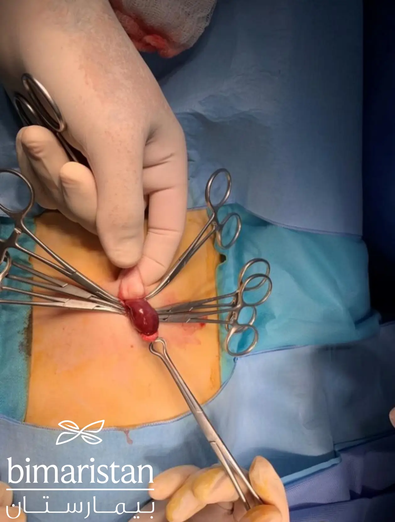 Image showing the operation of umbilical hernia in children