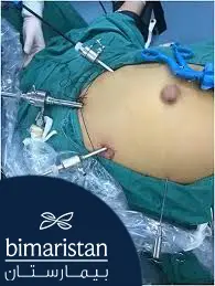 Kadınlarda göbek fıtığını tedavi etmek için endoskopik cerrahi prosedürü gösteren resim