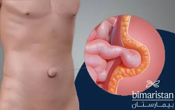 An image showing the occurrence of an umbilical hernia and the exit of intestinal loops through the hernia