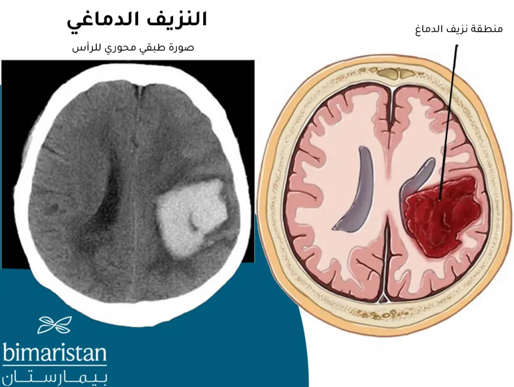 صورة طبقي محوري لنزيف الدماغ عند الكبار