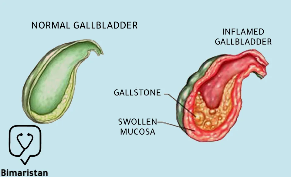 This image shows an inflamed gallbladder that causes symptoms of cholecystitis in women