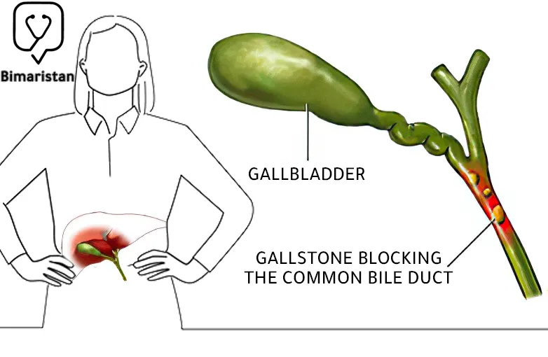 In this picture, we notice the presence of a gallstone blocking the bile duct, and thus symptoms of cholecystitis appear in women