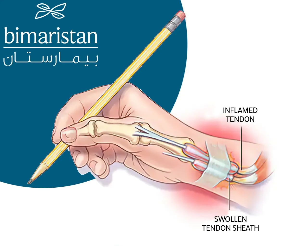 Image showing hand tendinitis, which is often caused by excessive use of the hands