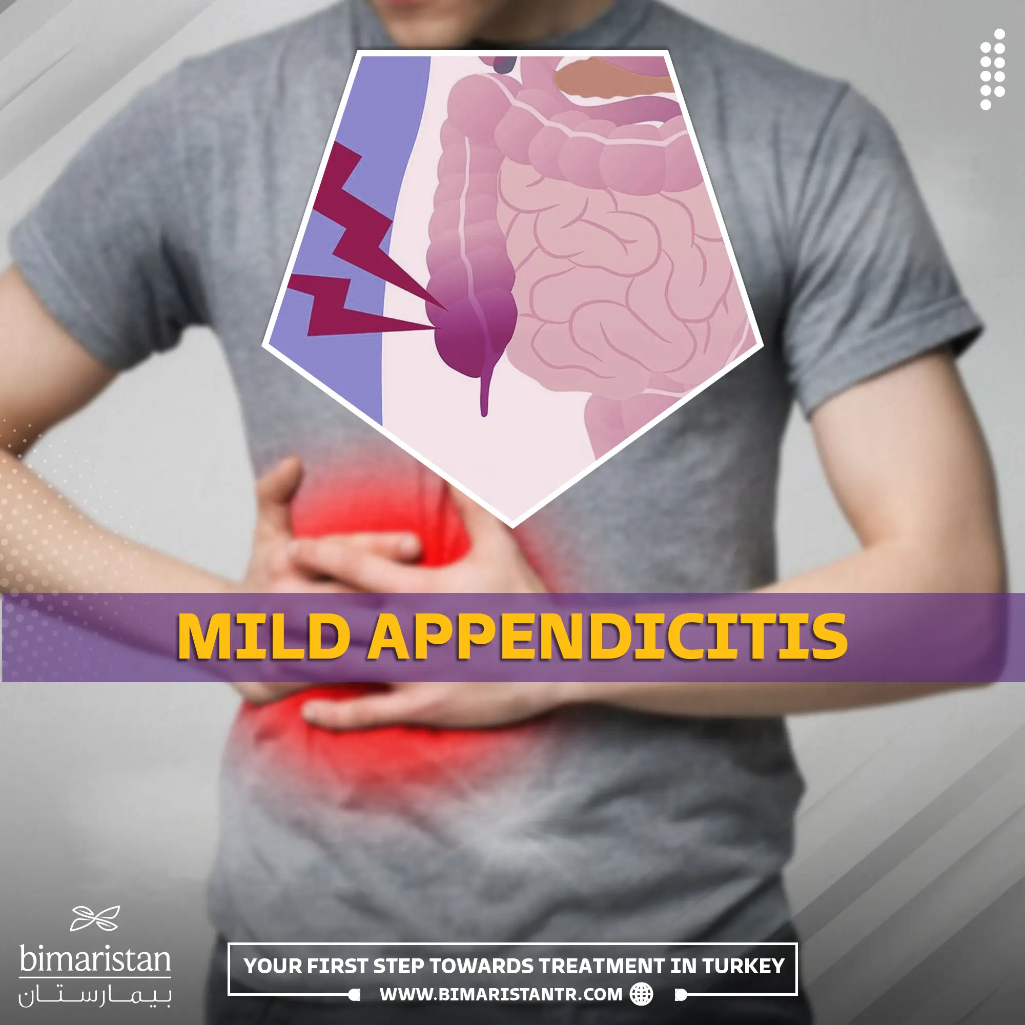 Mild appendicitis