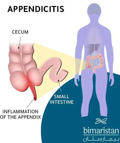 Image showing mild appendicitis and the anatomical location of the appendix in the body