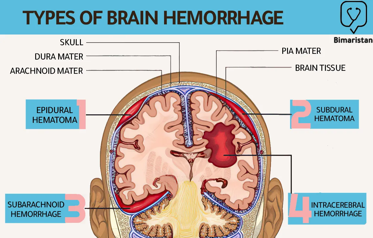 Types of internal bleeding in the head, which mainly divided into meningeal bleeding and intracerebral hemorrhage