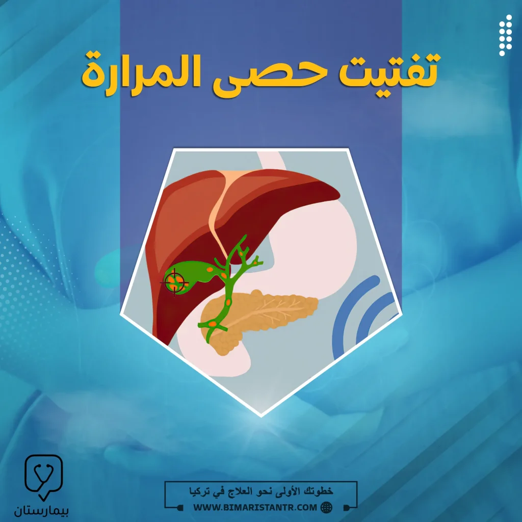 تفتيت حصى المرارة بدون عملية
