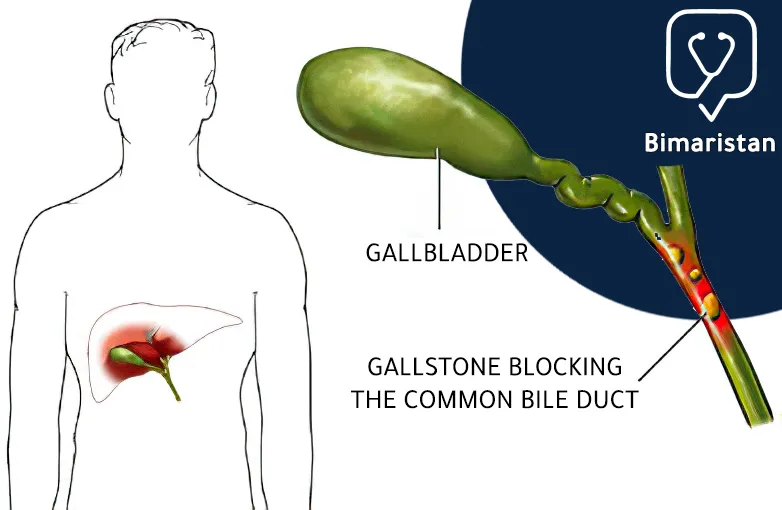 This picture shows the presence of a gallstone blocking the bile duct, which requires the need to break up gallstones to relieve symptoms.