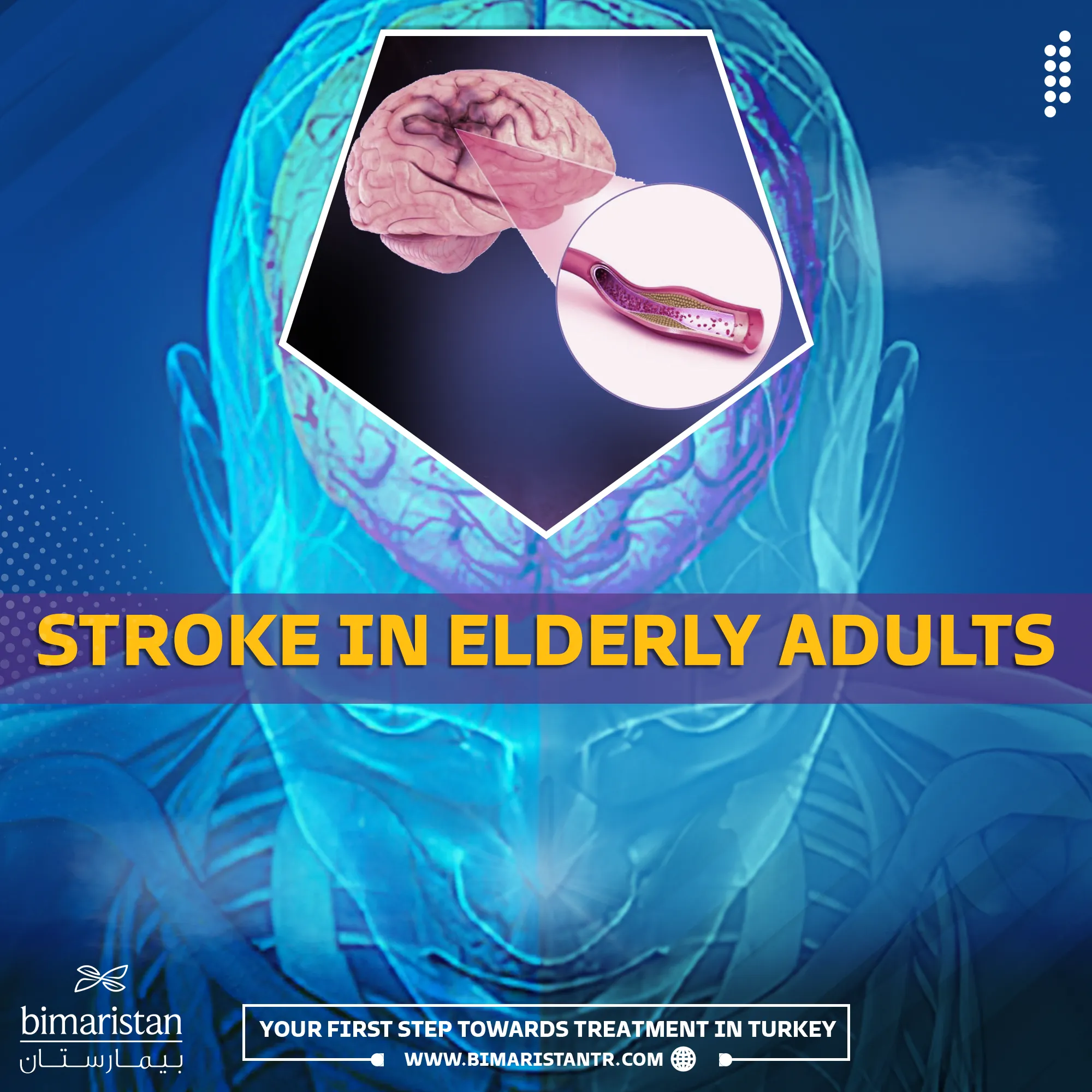 Ischemic stroke in the elderly