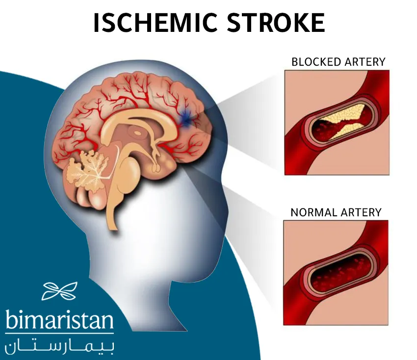 This image shows the blockage of a cerebral artery due to an ischemic stroke in the elderly
