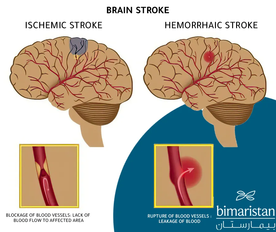 Types of stroke are divided into ischemic stroke in the elderly and cerebral hemorrhage
