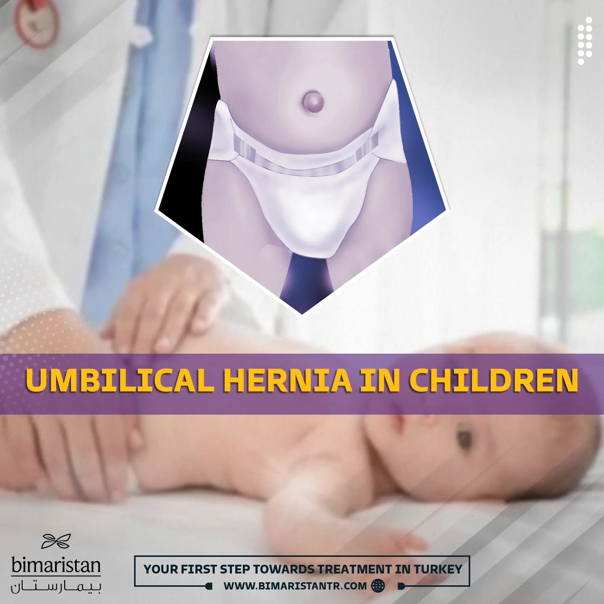 Cover image for the article Umbilical hernia in children