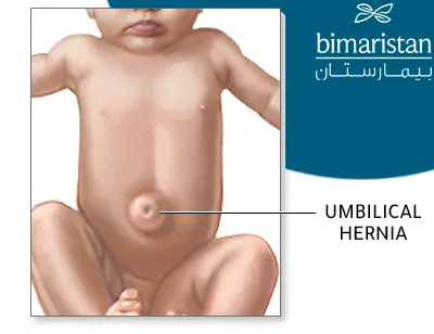 Image showing the shape of the umbilical hernia in children in the form of a bulge in the place of the child's navel