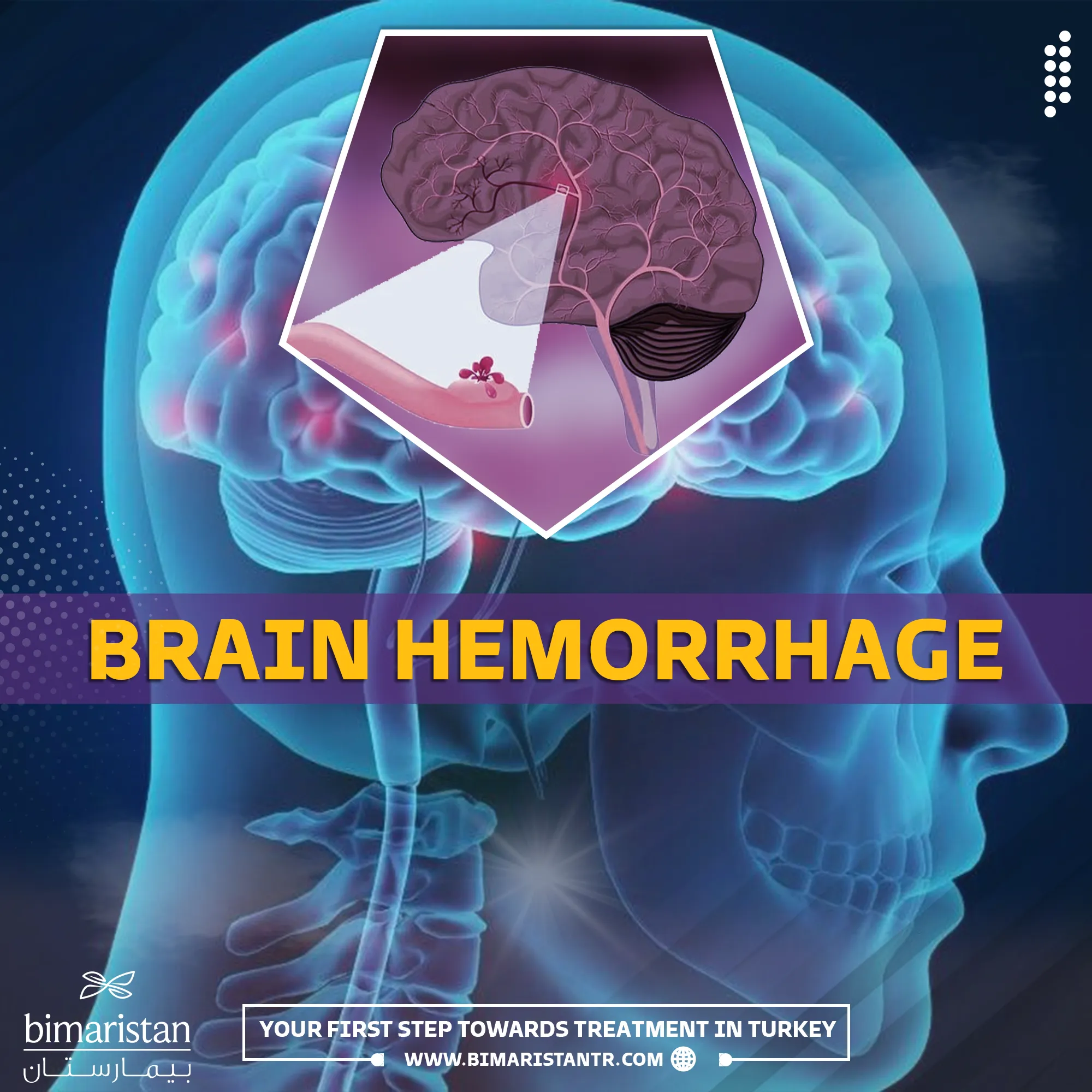 Brain hemorrhage in the elderly