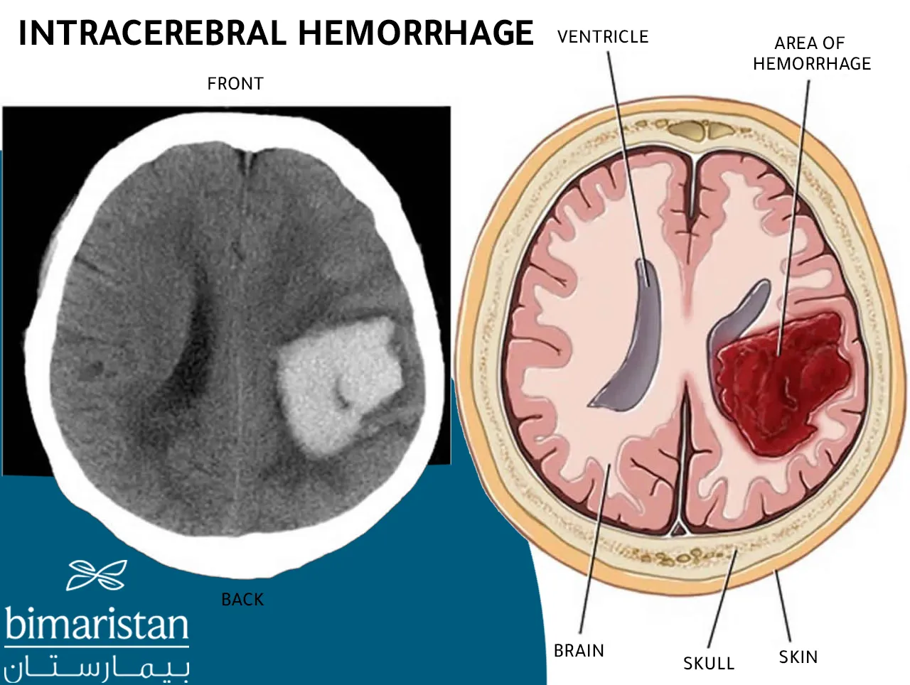 CT image that shows cerebral hemorrhage in adults