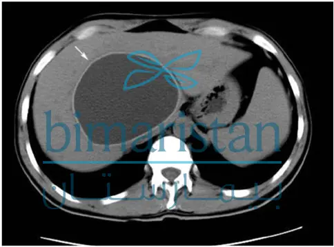 صورة بالتصوير الطبقي المحوري تظهر الكيس المائي في الكبد