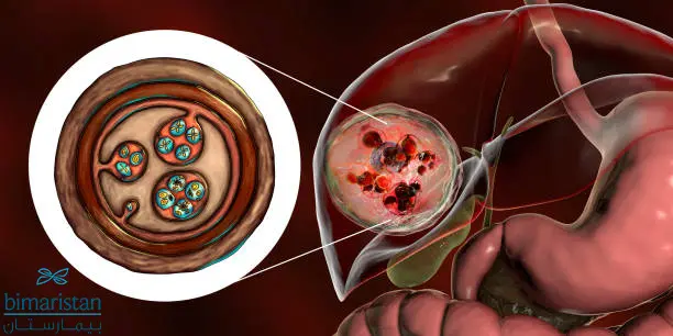 صورة ترسيمية لكيس مائي في الكبد وبداخله كيسات بنات وسائل