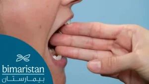 The normal mouth opening is approximately three fingers wide
