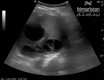 Echocardiography showing the presence of a multi-occult abscess in the spleen