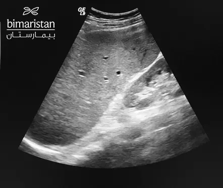 An echocardiogram showing an enlarged spleen in a child