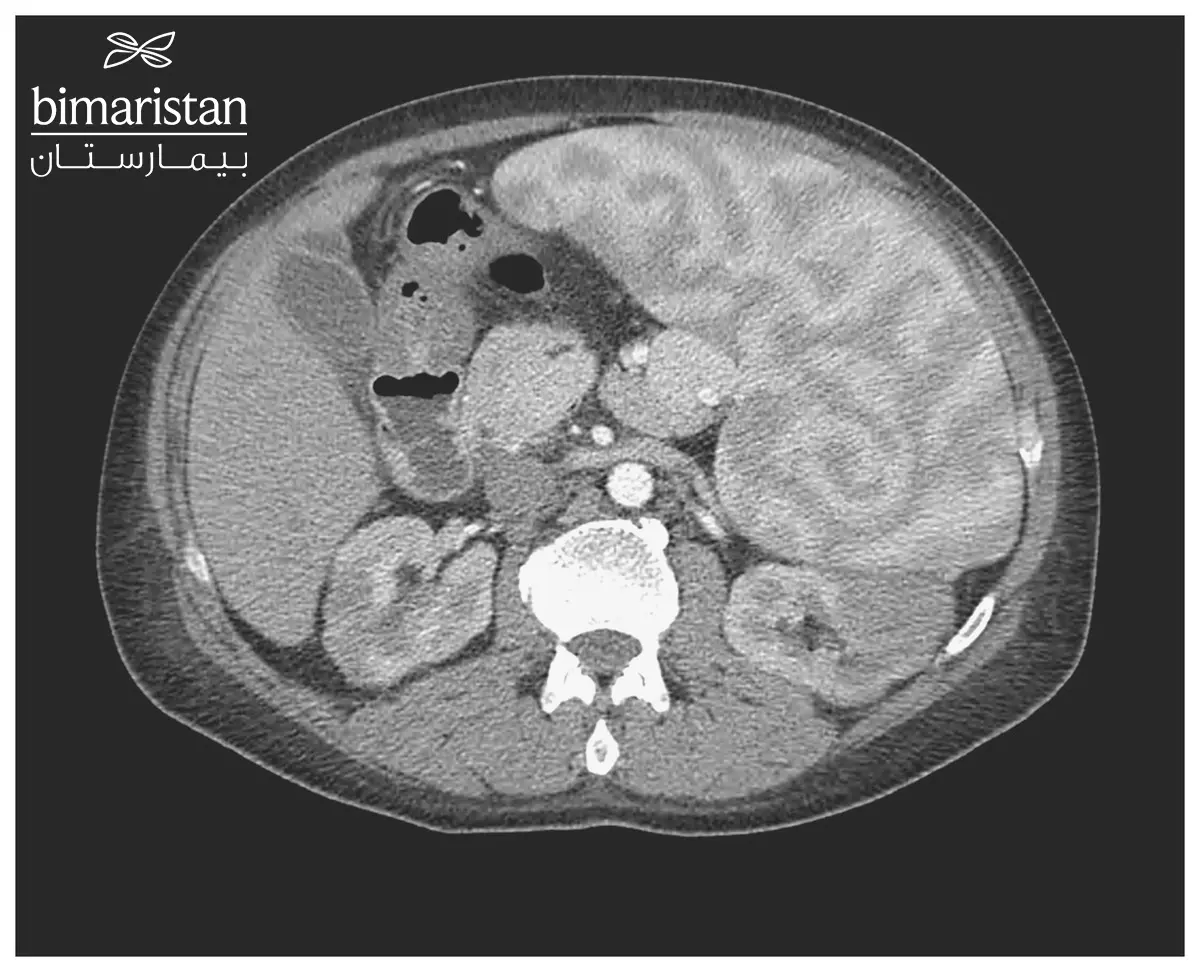 CT scan of a child's abdomen showing splenomegaly