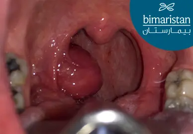 صورة توضح سرطان اللوزتين الذي يظهر كضخامة اللوزة عند فتح الفم
