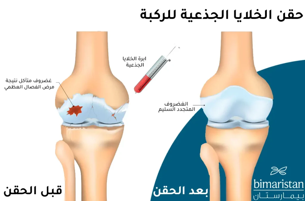 رسم توضيحي لمقارنة بين حالة المفصل قبل حقن الخلايا الجذعية للركبة وبعد مرورة فترة من الحقن