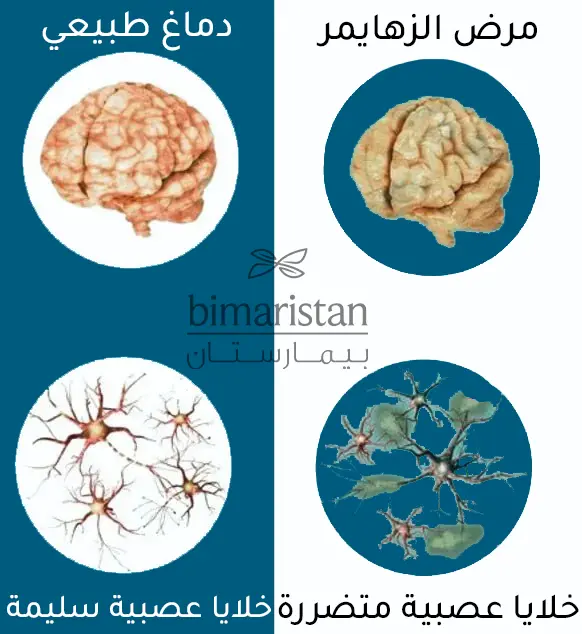 يهدف علاج الزهايمر بالخلايا الجذعية لتجديد الخلايا العصبية المتضررة في دماغ مريض الزهايمر كما توضح هذه الصورة