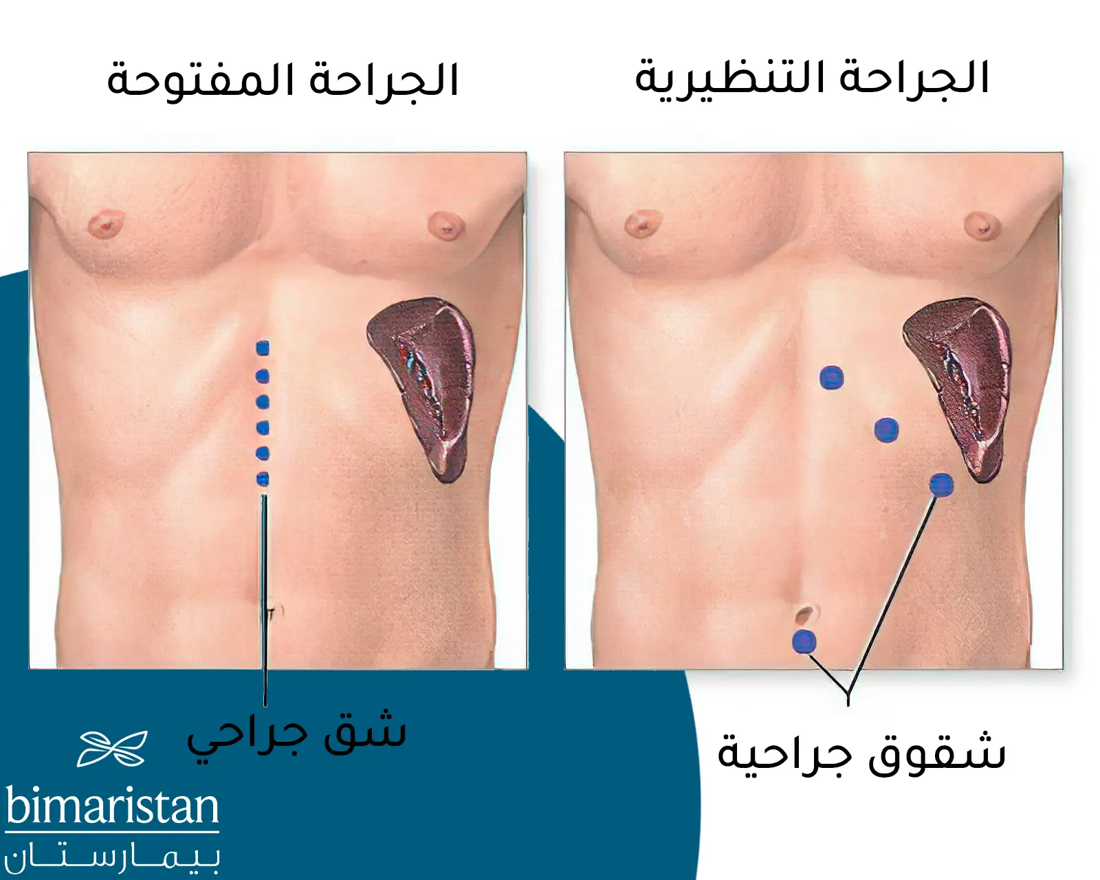 صورة توضيحية تبين الفرق بين الجراحة المفتوحة والجراحة التنظيرية في عملية استئصال الطحال